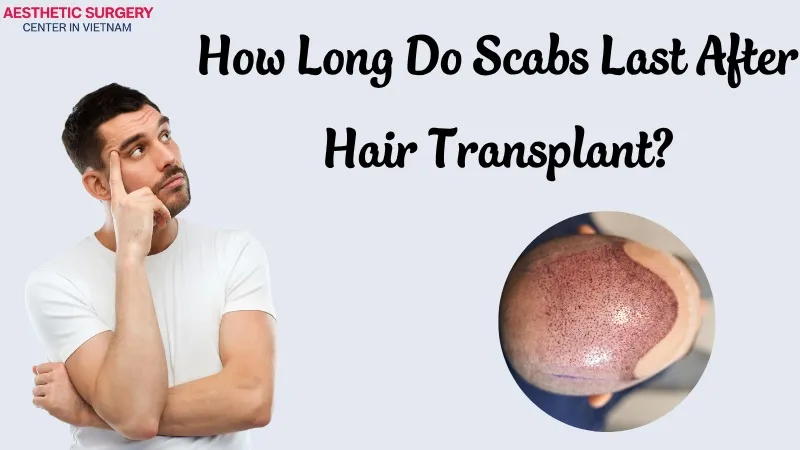 Hair transplant scabs typically last around 7–14 days, but the duration may vary depending on each individual’s healing process.