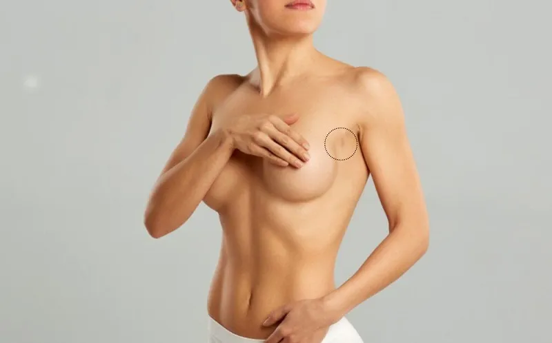 Underarm breast augmentation hides scars very well, ensuring high aesthetic results for the breasts after surgery.