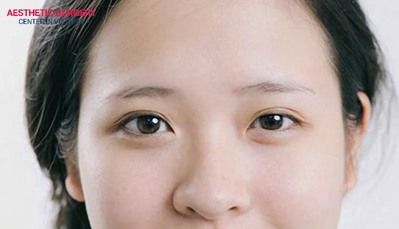 Uneven eyelids can originate from genetics.