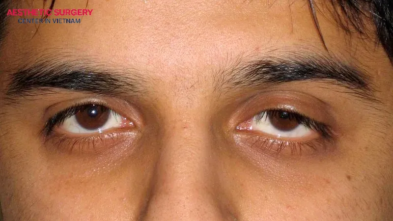 Individuals with pathological ptosis can also cause eyelids uneven.