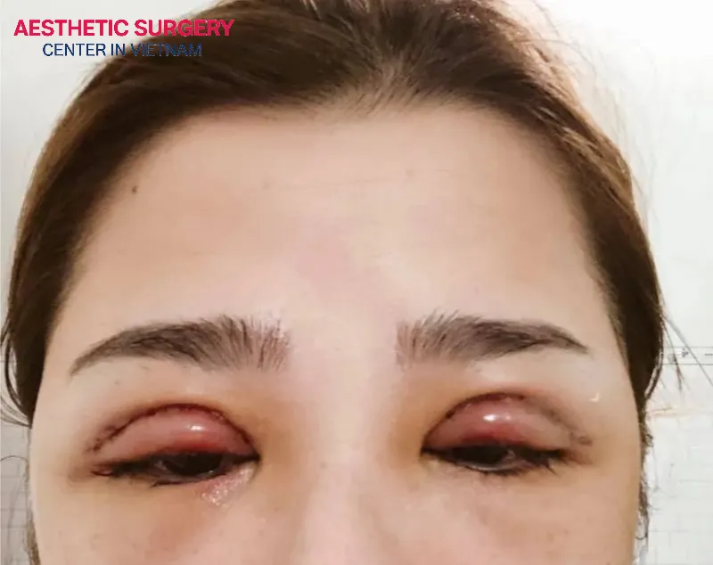 Post-surgical complications of eyelid surgery are also a cause of uneven eyelids.