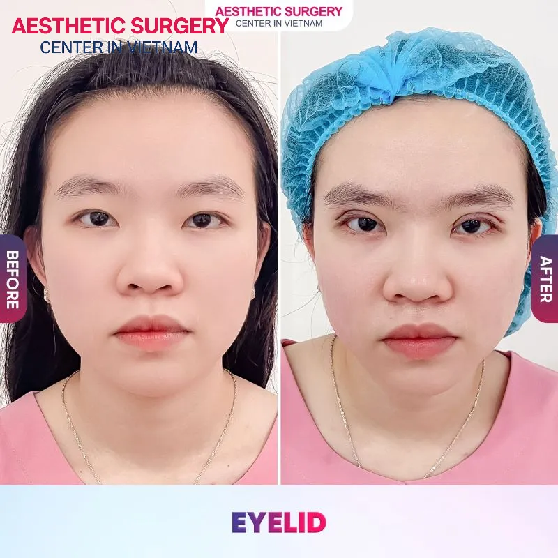 Create beautiful eyelid creases after eye aesthetic surgery at Aesthetic Surgery Vietnam