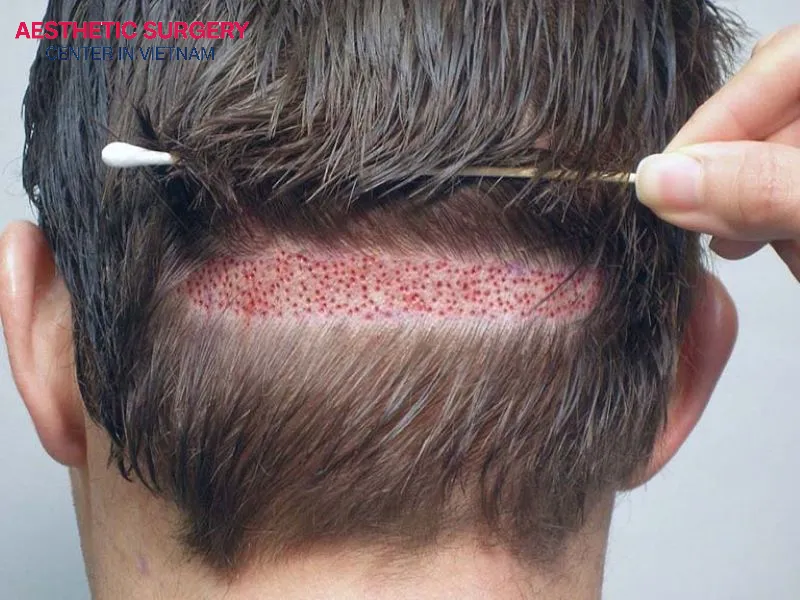 After a hair transplant, the scalp is still injured and prone to infection, so careful aftercare is essential, especially regarding the timing of hair washing.
