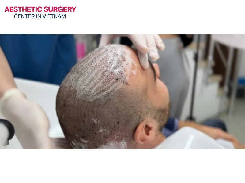 During days 4 to 10, you can wash your hair gently to keep the scalp clean and help prevent infection.