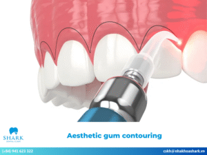 Aesthetic gum contouring: Who is it suitable for? Procedure details