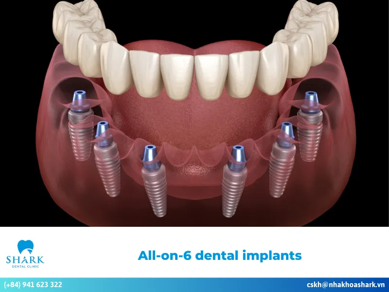 Are all-on-6 dental implants effective? What is the procedure like?