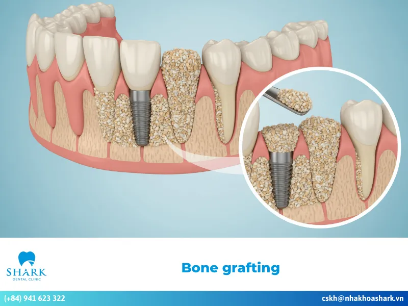 Dental bone grafting