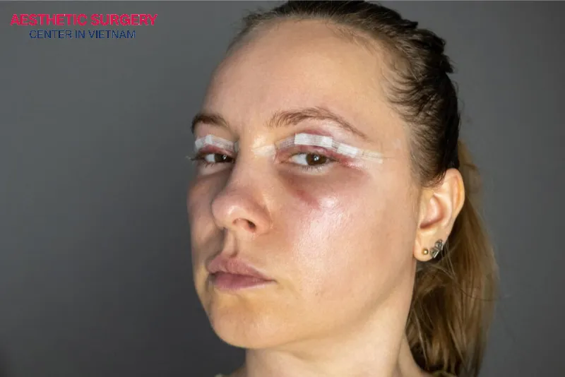 Hematoma or seroma under the skin after facelift surgery can create pressure, causing significant facial swelling.