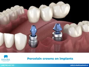 Porcelain crowns on implants: Procedure & Aftercare