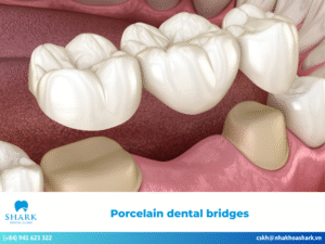 What are porcelain dental bridges? Pre-treatment essentials