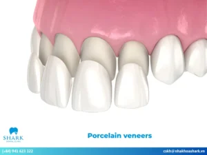 Porcelain veneers: Everything you need to know