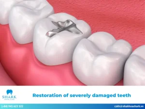 Restoration of severely damaged teeth: Solutions & Costs