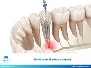 Root canal retreatment: Everything you need to know