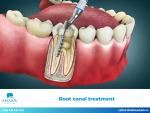What is root canal treatment? Benefits & Risks of root canals