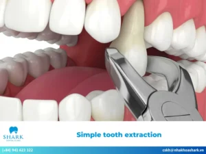 Simple tooth extraction: Procedure, cost, and post-extraction care