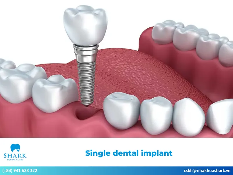 What is the procedure for a single dental implant? Things to note