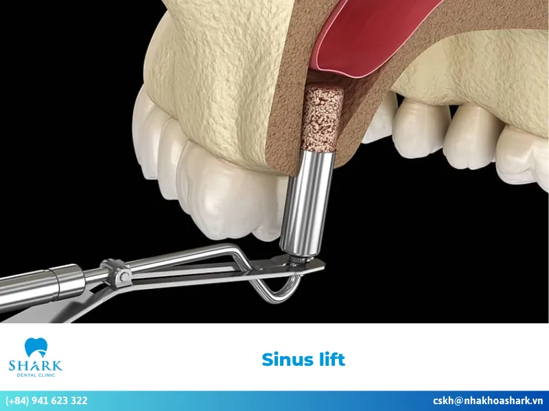 When is a sinus lift performed? Standard dental process
