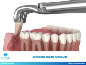Wisdom tooth removal: Procedure & potential complications to note