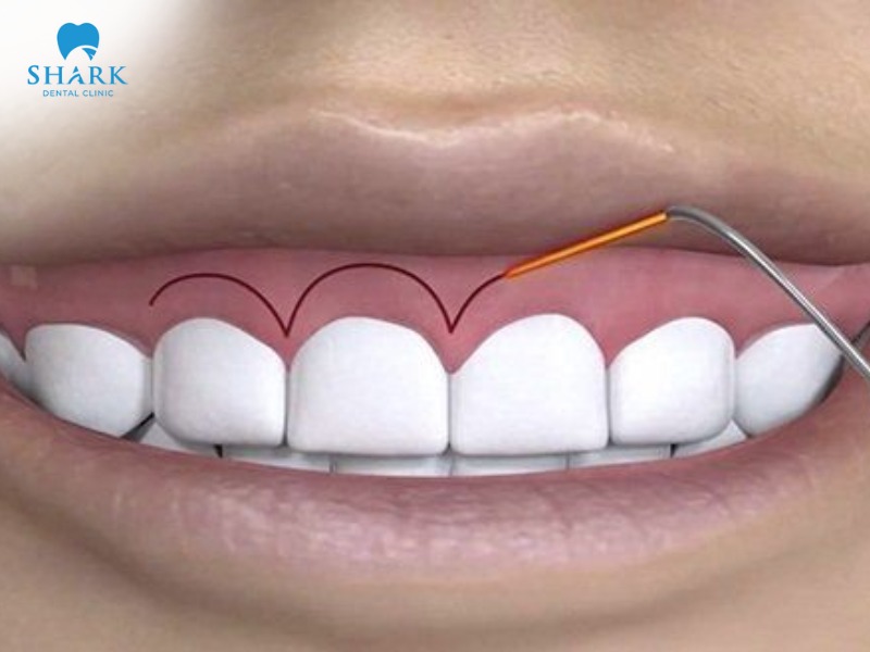 Gum contouring is minimally invasive and delivers high aesthetic results