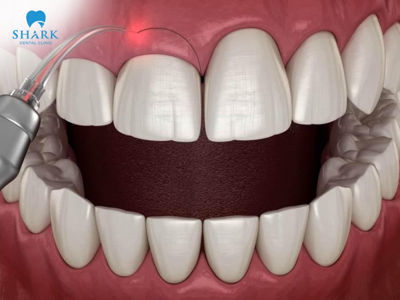 Laser gum contouring offers many outstanding advantages compared to traditional methods