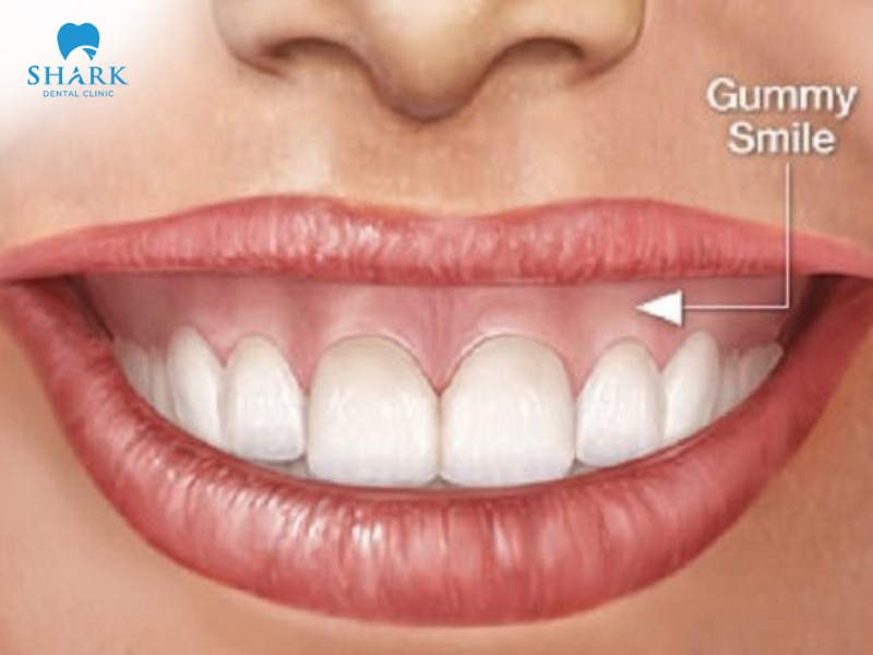 Gum contouring is suitable for cases such as gummy smiles and excessive or overgrown gum tissue