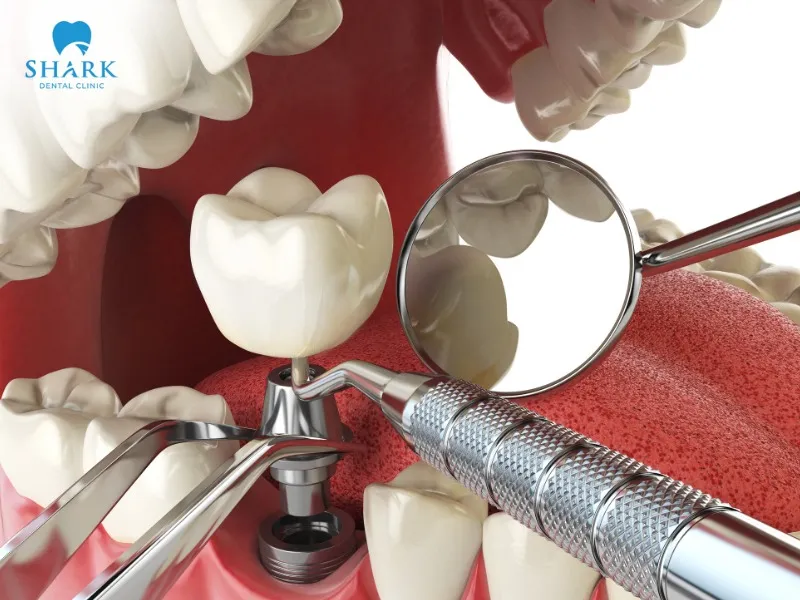 Single-tooth implant restoration offers many outstanding advantages compared to porcelain dental bridges
