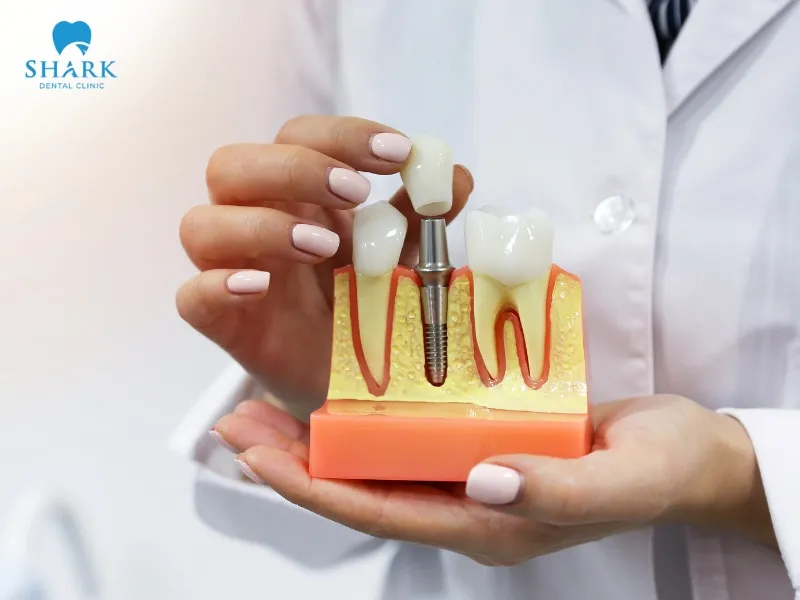 Dental implant placement provides highly effective tooth restoration, ensuring aesthetics and significantly improving chewing function