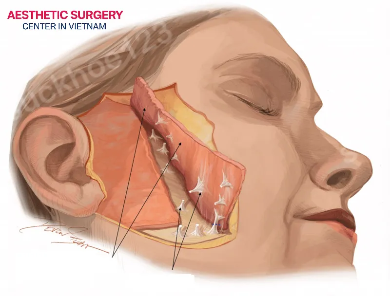 The deep plane facelift cost worldwide typically ranges from USD 40,000 to USD 100,000.