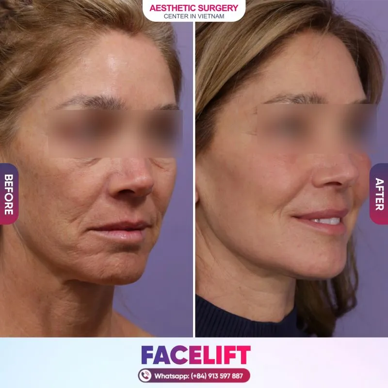 Choosing reputable facelift providers in Vietnam allows you to experience quality service at a reasonable cost.