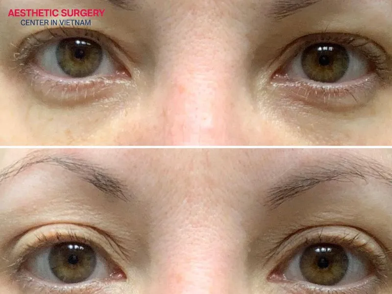 Eyelid tape provides temporary results for creating bigger, rounder-looking eyes.