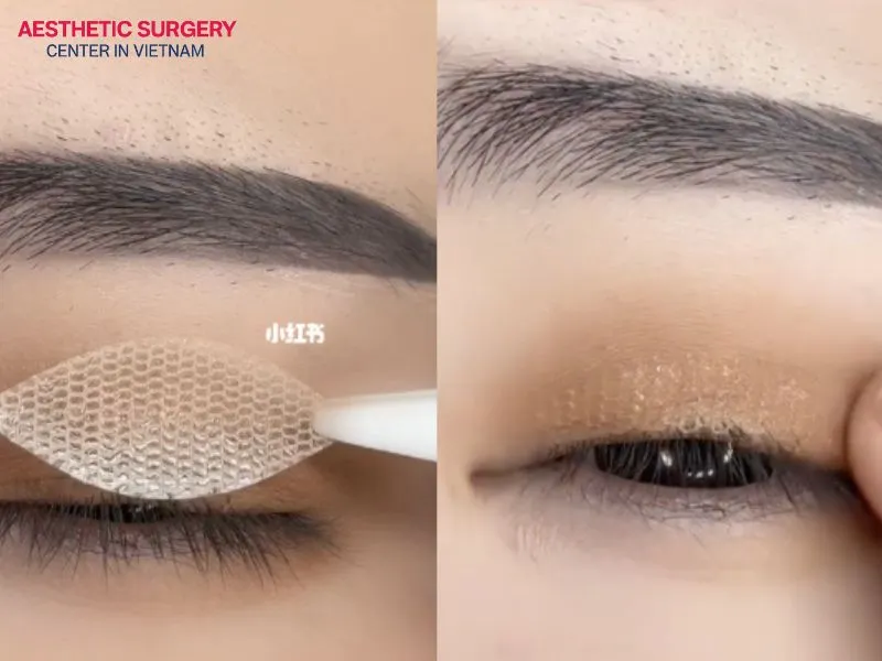 Using eyelid tape incorrectly can easily cause itching in the eyelid area.