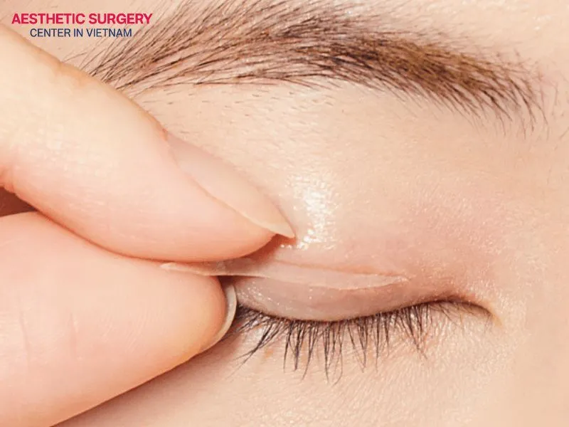 Both eyelid tape and blepharoplasty have their own advantages and disadvantages.