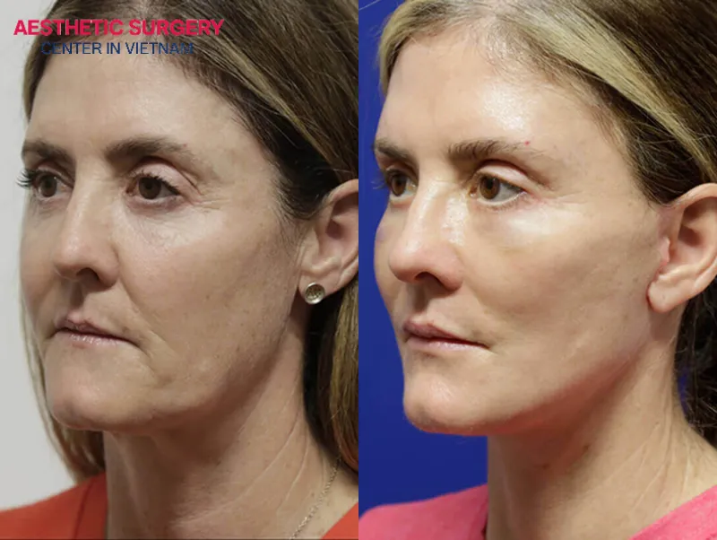 The woman’s face, which had many wrinkles and looked tired, became more youthful and energetic after the endoscopic facelift.