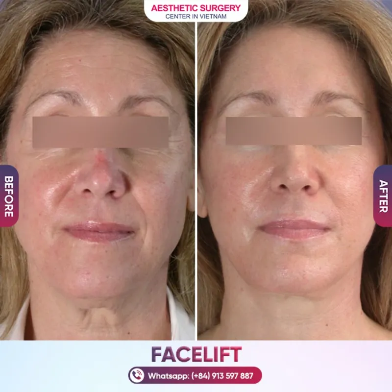 Client results before and after undergoing an endoscopic facelift at Aesthetic Surgery Center In Vietnam.