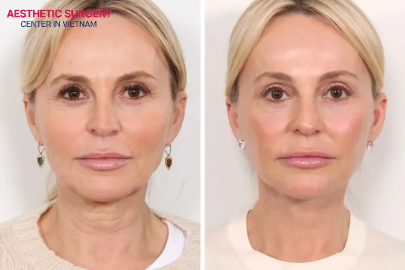 An endoscopic facelift is usually suitable for patients with mild to moderate sagging.