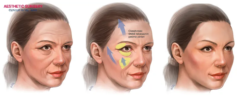 After an endoscopic facelift, the wounds usually heal within about 5–7 days.