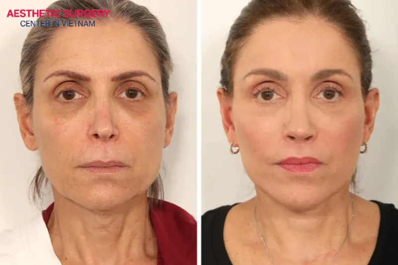 The client looks about 10 years younger after undergoing an endoscopic facelift.