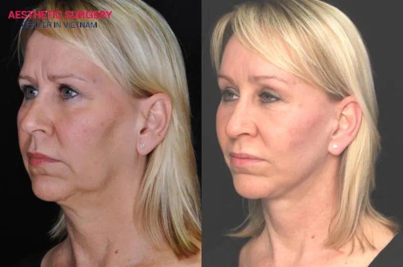 The crow’s feet and smile lines on the client’s face were significantly improved after the endoscopic facelift.