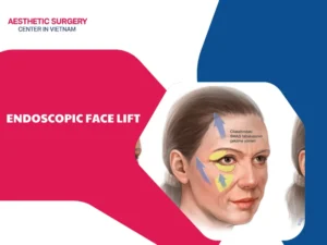 endoscopic face lift
