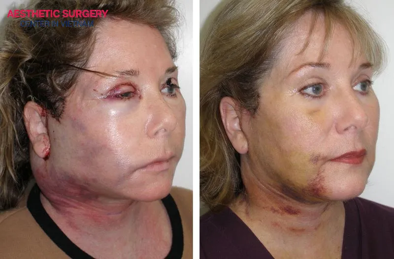 Excessive swelling after facelift surgery usually occurs within the first 48–72 hours.