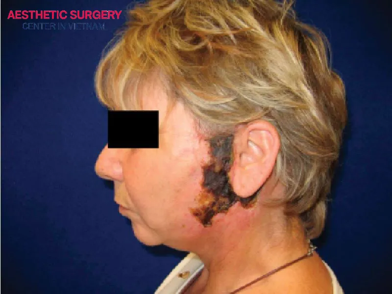 A low-quality facelift procedure with poor hygiene and technical errors can cause infection, leading to facial swelling.