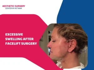 What causes excessive swelling after facelift surgery?