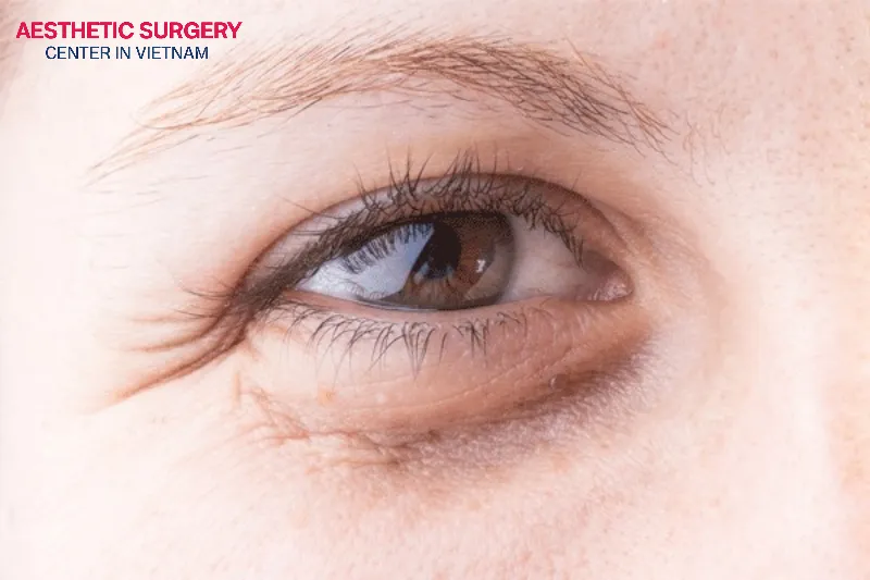 Patients with excess eyelid skin often lose their eyelid crease or develop multiple creases, have drooping outer corners of the eyes, and show many crow’s feet.