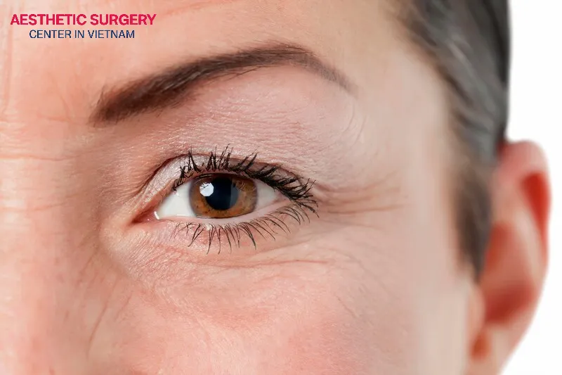 Eyelid skin drooping is often caused by the body’s natural aging process.