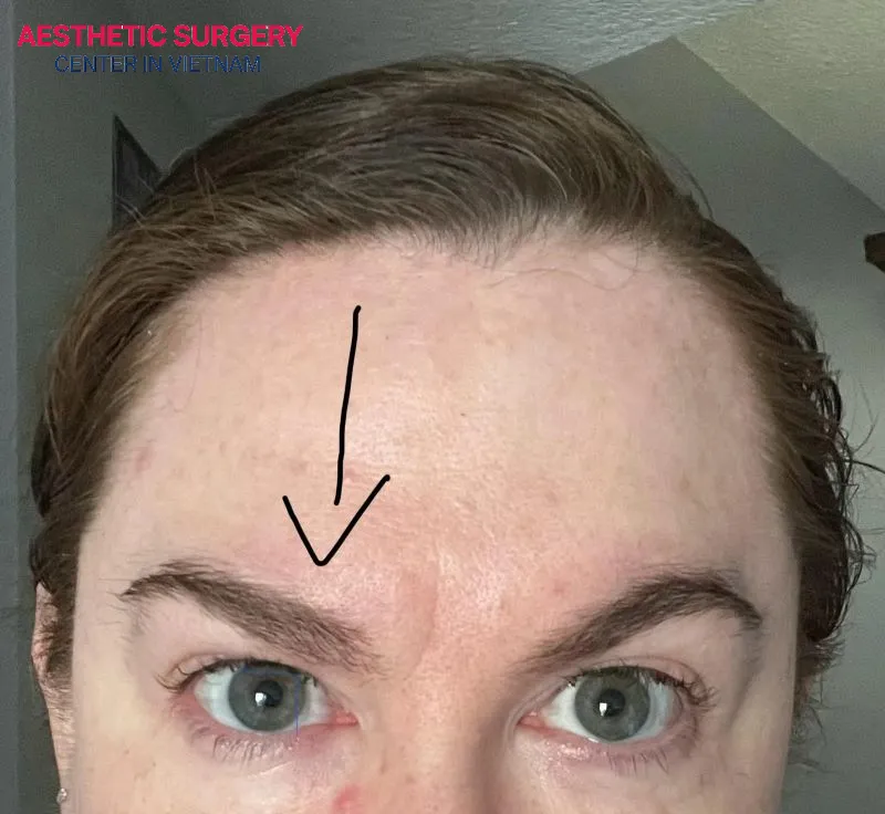 Eyebrow droop after botox injections is usually caused by injections placed too low or an excessive botox dosage.