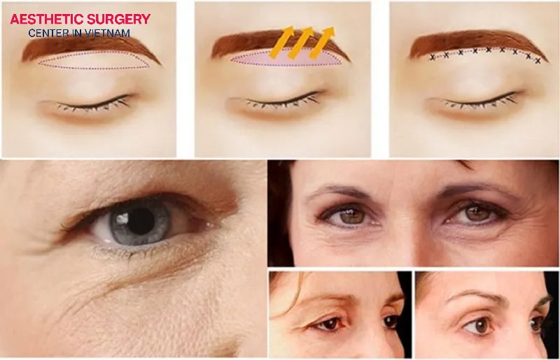 An eyebrow lift is also an effective method to correct sagging brows.
