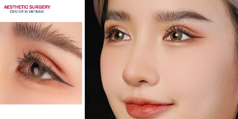 Double eyelids are often preferred in certain aesthetic standards because they can create a more defined and open eye appearance.