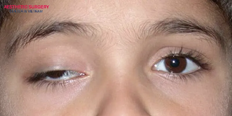 Droopy eyelids, also known as ptosis, are an eyelid type that is usually caused by congenital factors or aging.