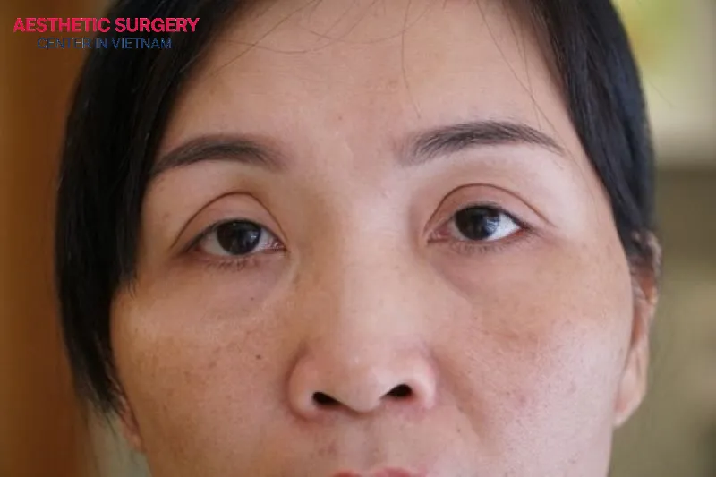 Uneven eyelids with multiple folds are also one of the common eyelid types.