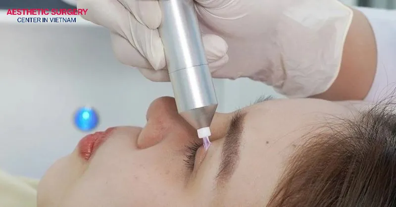 Apply modern technologies such as plasma, laser, and RF to improve loose eyelid skin and correct droopy eyelids.